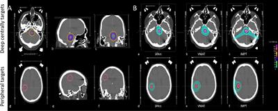 Redefine the Role of Spot-Scanning Proton Beam Therapy for the Single Brain Metastasis Stereotactic Radiosurgery